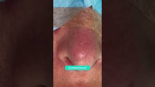 HANGING COLUMELLAR REDUCTION  DR TANVEER JANJUA NEW JERSEY [upl. by Thetis]