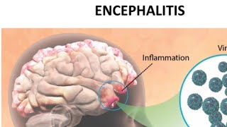 Encephalitisइंसेफेलाइटिस MSN22ND YEAR GNM [upl. by Yonatan719]