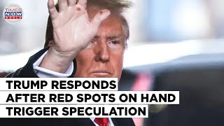 Donald Trumps Reaction to Speculation Over Red Spots on Hand  World News Update [upl. by Ahseina422]