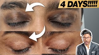 How To Get Rid Of Under Eye Dark Circles In 4 days WITHOUT Filler Skincare… [upl. by Reisinger]