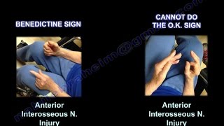 Anterior Interosseous nerve O K Sign  Everything You Need To Know  Dr Nabil Ebraheim [upl. by Wernher56]