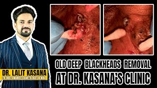 OLD DEEP BLACKHEADS REMOVAL AT DRKASANAS CLINIC [upl. by Sternberg]