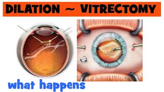 How long does eye dilation last My vitrectomy after a year [upl. by Dionis]