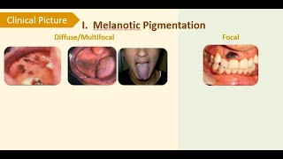 3 Physiologic smokers amp druginduced melanosis [upl. by Atiuqehc]