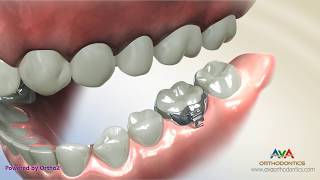 Orthodontic Band Placement on a Molar [upl. by Slaby]