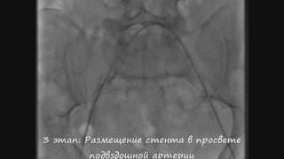 Стентирование наружной подвздошной артерии [upl. by Nosirb905]