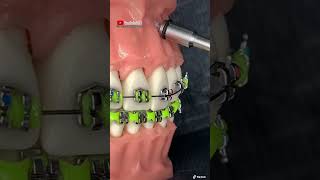 ¡Instalación de microimplante dental en los BRACKETSBRACESFRENILLOS ORTODONCIA [upl. by Malloch]