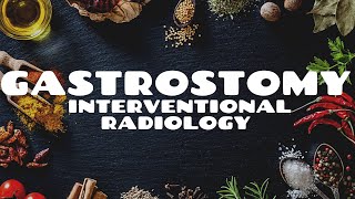 Gastrostomy Nutrition Tube Placement by Interventional Radiology [upl. by Niko]