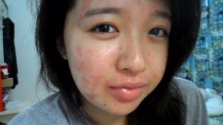 My Acne Story 15th Week of Accutane [upl. by Kenyon]