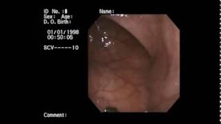 Endoscopic detorsion of volvulus segmoid دكتور مسعد حميدة [upl. by Childers]