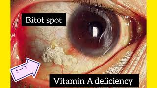 Bitot Spot  Vitamin A Deficiency  Dr Shahans Class [upl. by Sinclair]