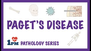 Pagets Disease  Pathology Causes Symptoms Diagnosis Treatment [upl. by Luckin]