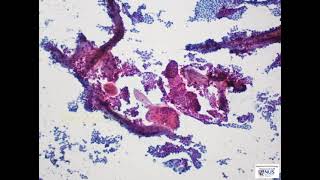 Thyroid cytology  Classical papillary thyroid carcinoma [upl. by Annoved]