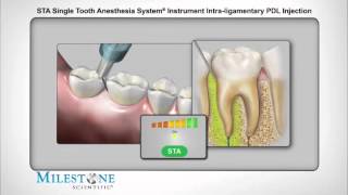 STAмодифицированая интралигаментарная анестезия [upl. by Linder322]