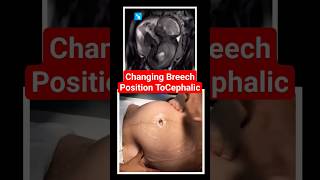 changing breech baby to cephalic position brechbaby babyultrasound babypositionpregnancy [upl. by Barbi217]