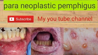 skin disease para neoplastic pemphigus [upl. by Letnwahs49]