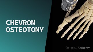 Chevron Osteotomy [upl. by Nalyk]