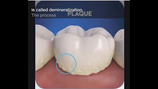 Stage 1 of Tooth Decay Demineralization [upl. by Anah]