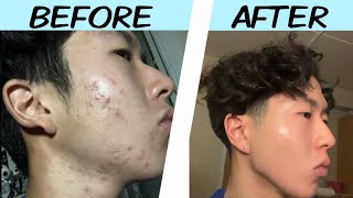 My Acne Journey Skincare Motivation [upl. by Ahsiened]