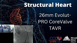 26mm EvolutPRO CoreValve TAVR  March 13 2018 [upl. by Kenton]