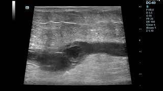 Superficial Thrombophlebitisthrombosis of Great Saphenous Vein [upl. by Claudian]