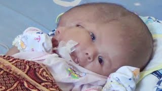 Parents Pray for Miracle After Their Baby Is Born With 2 Faces [upl. by Ahsenev]