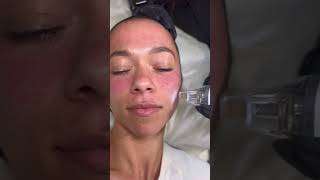 Potenza RF Microneedling at SEV Laser [upl. by Halima452]