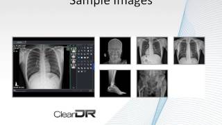 ClearDR 14 x17 Wireless DR Digital Xray Panel [upl. by Bomke]