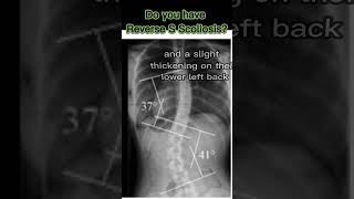 Reverse S Scoliosis [upl. by Orna]