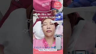 Exilis Ultra 360 for tightening your face  Yada Clinic Pattaya [upl. by Anidualc]