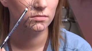 BOTOX PLANO DALLAS TUTORIAL LOWER FACE [upl. by Cram260]