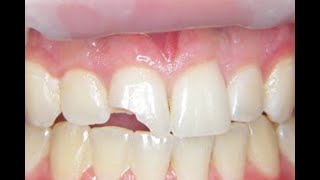 Fix a Chipped or broken tooth at home cheap [upl. by Slavic500]