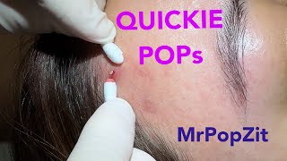 Quickie keratin plug core pops Acne extractions Link below to MrPopZit Live [upl. by Imar]