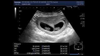 Ultrasound Video showing scan of an early twin pregnancy [upl. by Ninaj]