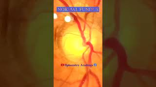 Normal fundus  Normal Retina  Smartphone Fundus Videography  Fundus Photography  Short Video 176 [upl. by Sessilu]