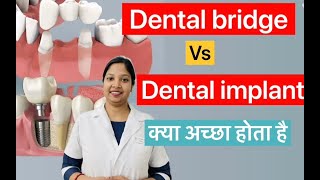 Dental bridge vs dental implant यह दोनों में क्या अच्छा है implant या bridge [upl. by Siusan]