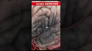 कैसे लकवा आता हैHow does stroke occur animation videoshortsanimation [upl. by Zobias]