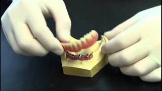 Prothese clipsee sur implant avec barre [upl. by Michiko]