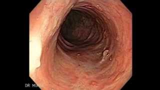 Colonoscopy of Ulcerative Colitis [upl. by Annairt]