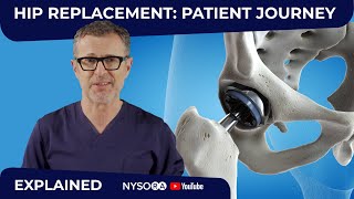 HIP REPLACEMENT SURGERY WHAT TO EXPECT [upl. by Faunie]