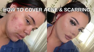 how i cover my acne with makeup [upl. by Berry]