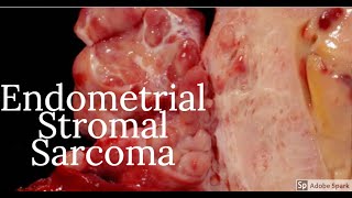 Digital Surgical Pathology 38 Endometrial Stromal Sarcoma [upl. by Maurice]