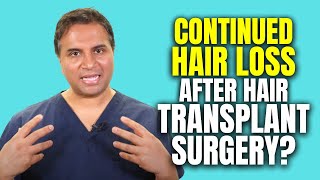 Continued Hair Loss After Having Hair Transplant Surgery [upl. by Haelem]