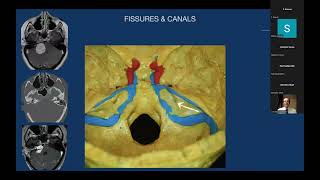 Anatomy and Surgical Approaches to Petrous Bone  Professor Pablo Gonzalez [upl. by Herstein]