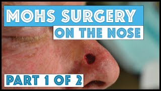 Mohs Surgery on the nose Part 1 of 2 Taking Mohs Layers [upl. by Essy530]