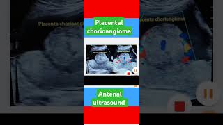 ultrasound antenatalplacental chorioangiomapregnancyultrasound [upl. by Couq]