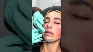 Lip Filler Technique using Hyaluronic Acid Filler fillersinjection lipsfiller filler [upl. by Finstad]