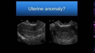 AIUM Webinar Problem Solving with 3D Sonography of the Uterus and Adnexa [upl. by Nilesoj]