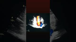 Mitral valve prolapse severe Mitral Regurgitation echocardiography cardiology [upl. by Assadah]