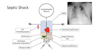 Septic Shock [upl. by Annavahs]